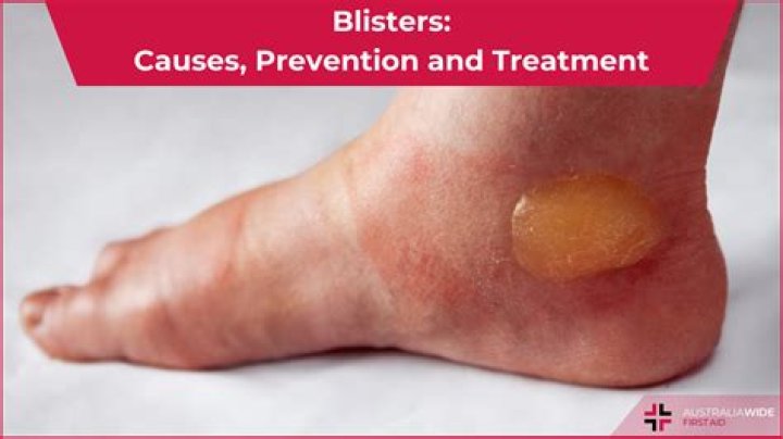 What causes blisters? Probably your socks